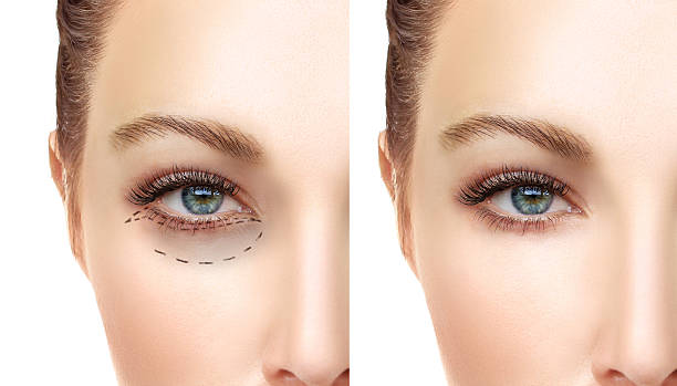 Botox and Dermal fillers results on a woman