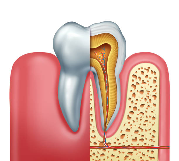 Root canal infection